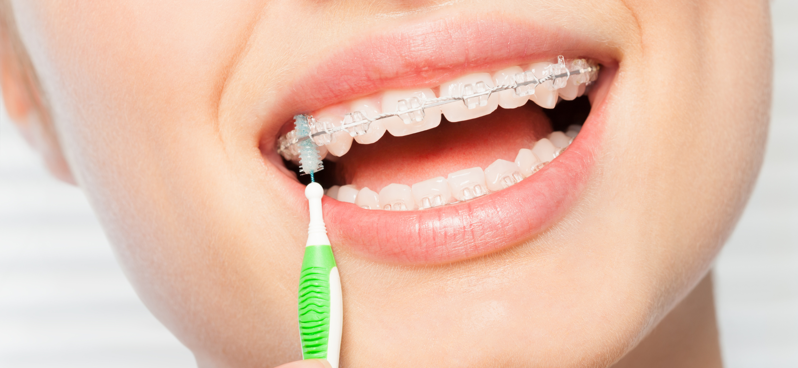 El cuidado de la boca con ortodoncia: Consejos del Colegio de Odontlogos de Cantabria